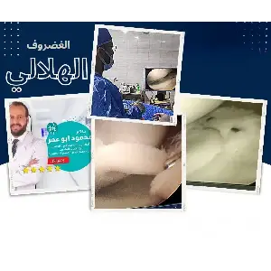 الغضروف الهلالي الخارجي